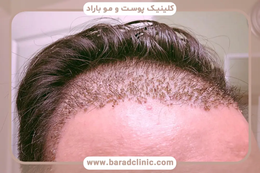 شستشوی موها در دوران نقاهت کاشت مو