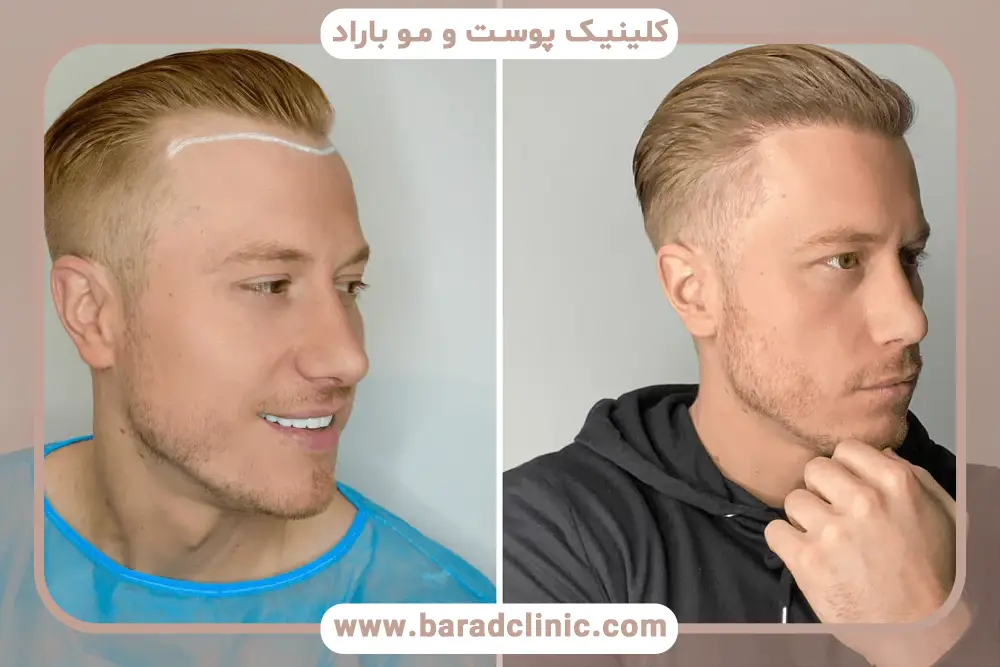 ماه دوم تا سوم دوره کاشت مو