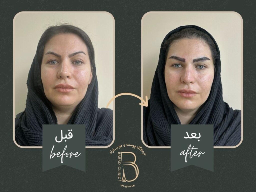 عکس کاشت ابرو بعد از چند ماه