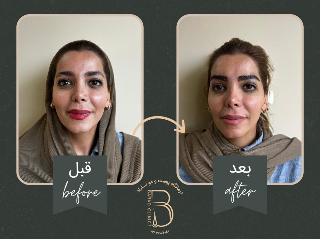عکس کاشت ابرو بعد از چند ماه