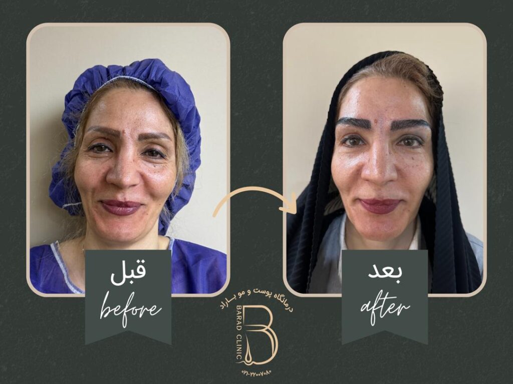 عکس کاشت ابرو بعد از چند ماه