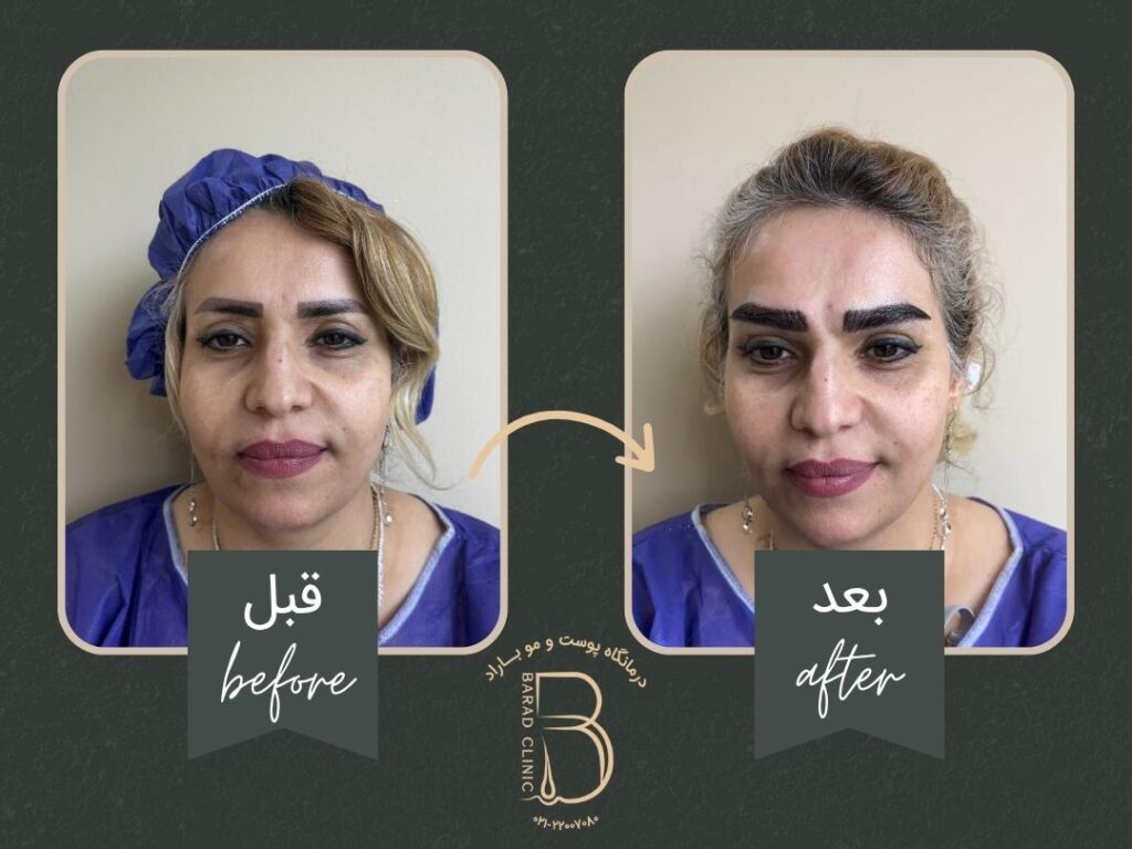 عکس کاشت ابرو بعد از چند ماه