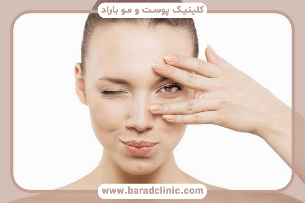 برداشت فلپ در کاشت ابرو