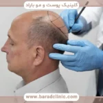 فیلم کاشت مو از اول تا اخر