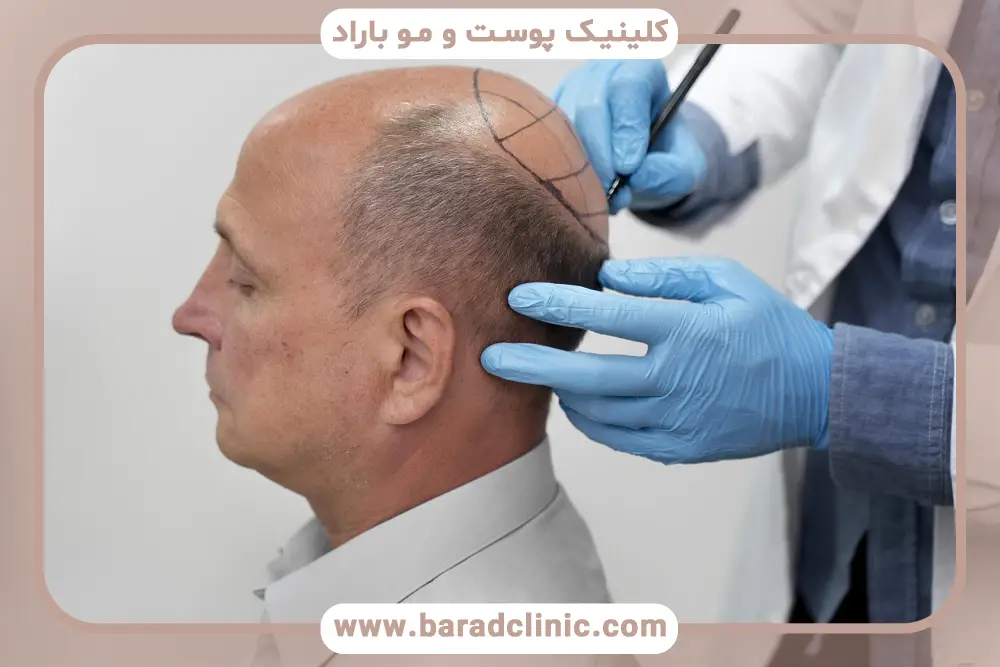 فیلم کاشت مو از اول تا اخر