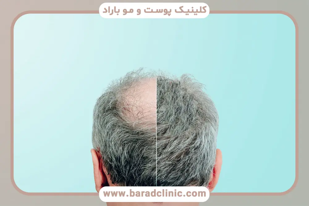 کاشت مو پشت سر