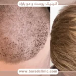 عکس کاشت مو تازه