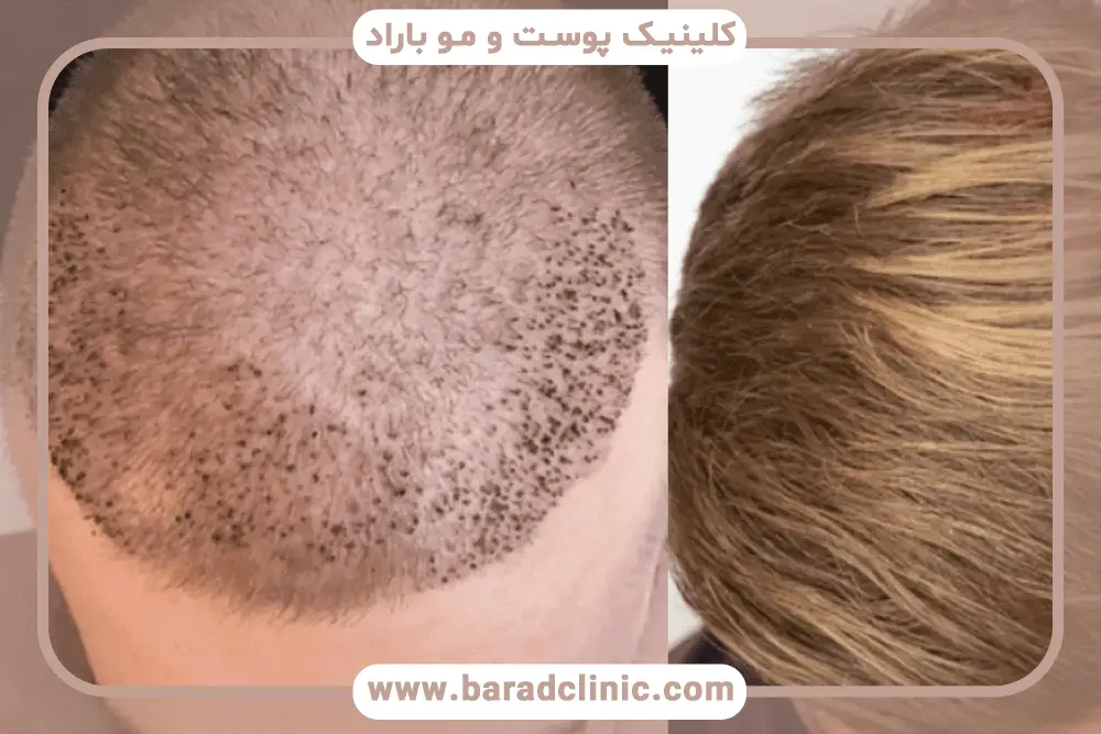 عکس کاشت مو تازه