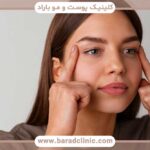 درمان ریزش ابرو