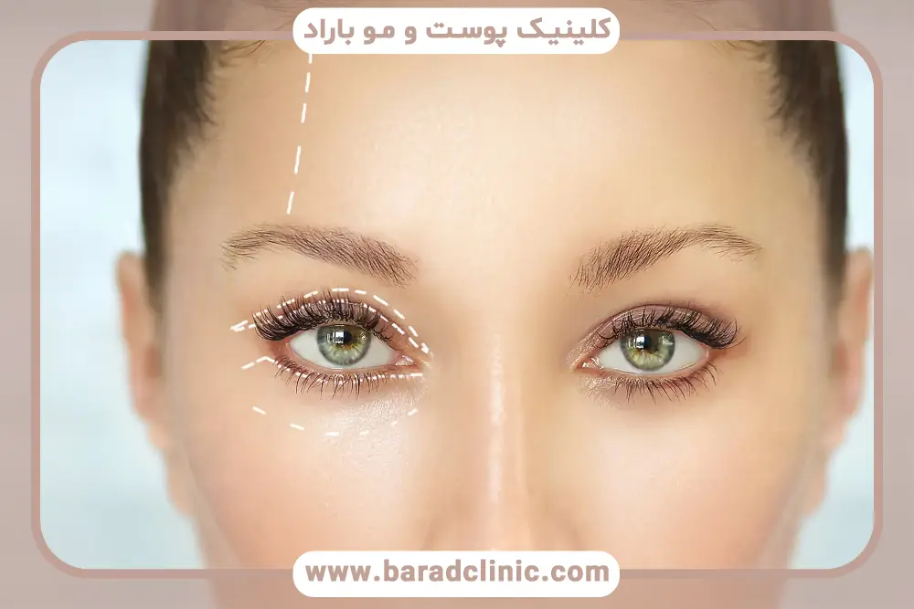 بلفاروپلاستی برای پوست شل و چروک خورده