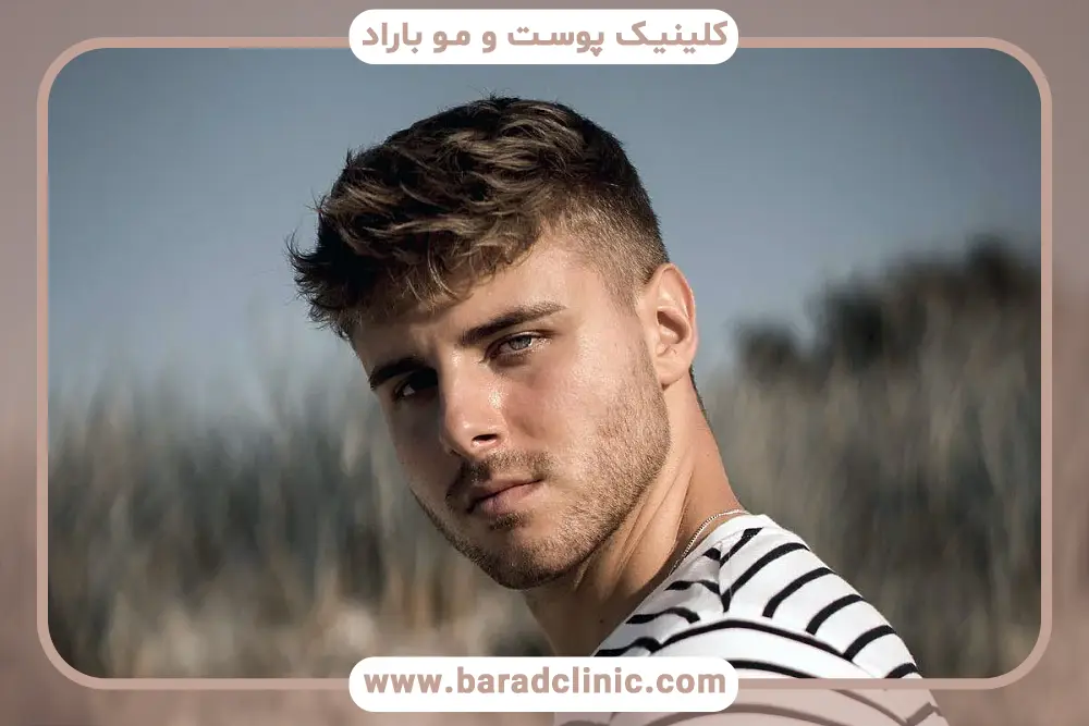 آمپول بیوتین و بپانتین بعد از کاشت مو