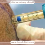 عوارض آمپول بی حسی کاشت مو