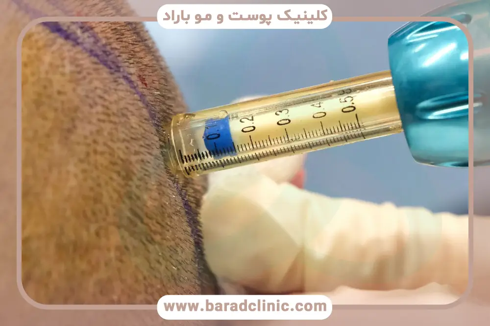 عوارض آمپول بی حسی کاشت مو