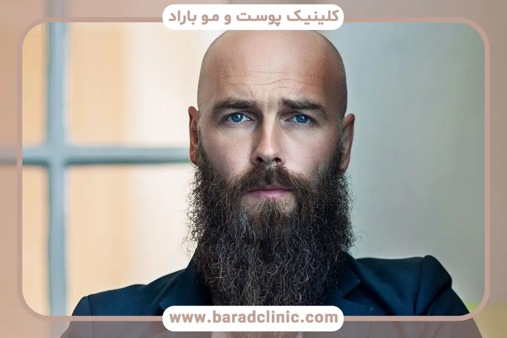 کاشت ریش به روش DHI