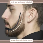 بهترین کلینیک کاشت ریش بدون جراحی در تهران