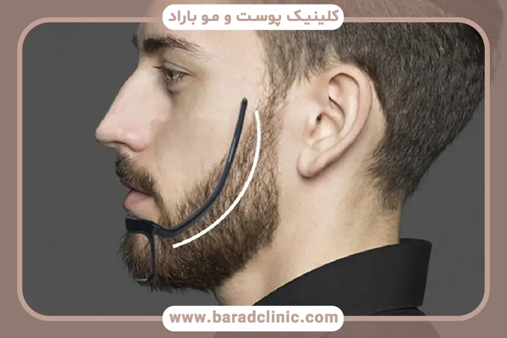 بهترین کلینیک کاشت ریش بدون جراحی در تهران