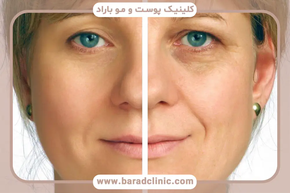 بلفاروپلاستی سنتی