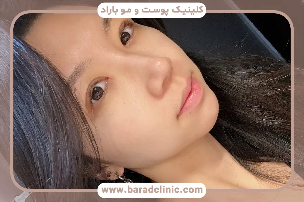 جدیدترین روش بلفاروپلاستی