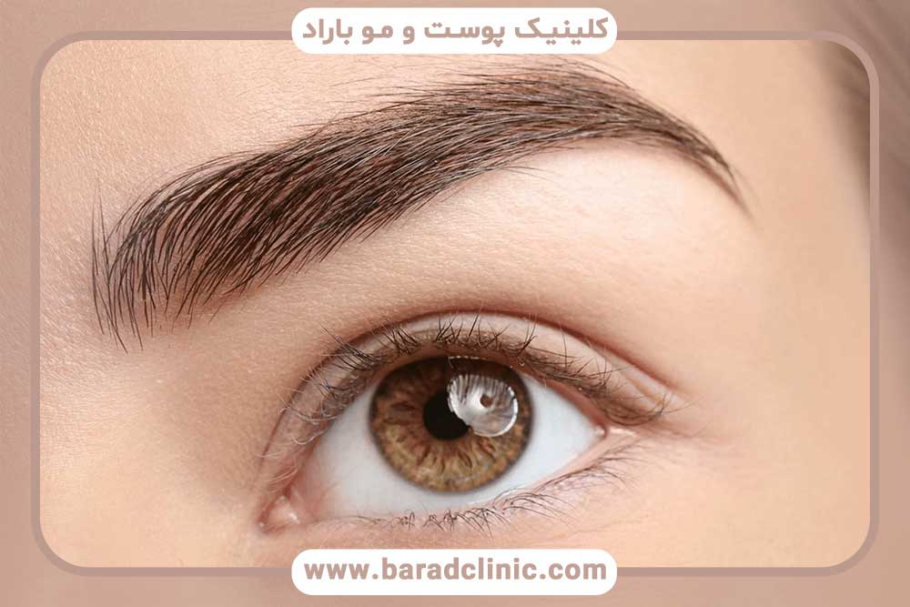 کاشت ابرو اقساطی قلهک