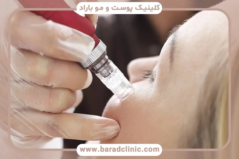 آیا prp صورت را چاق میکند