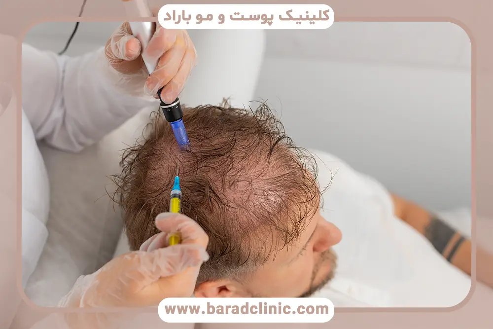 مزوتراپی مو هر چند وقت یکبار