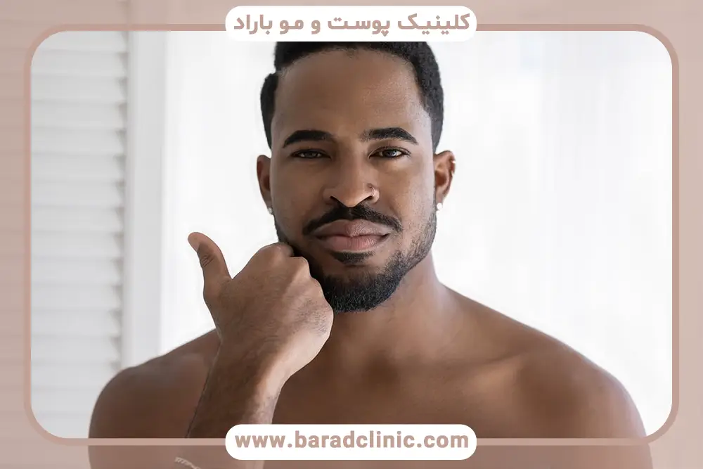 انواع کاشت ریش