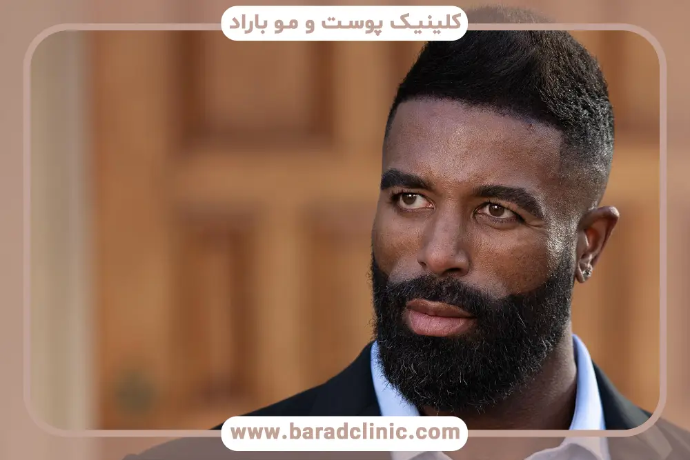 انواع روش کاشت ریش