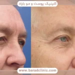 جراحی بلفاروپلاستی فوقانی