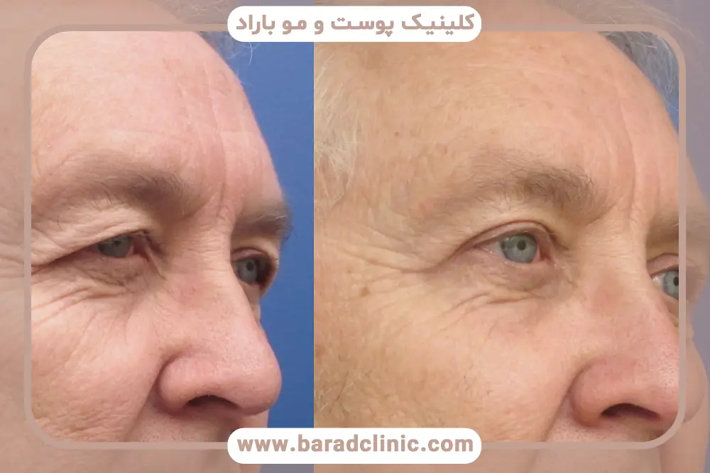 جراحی بلفاروپلاستی فوقانی