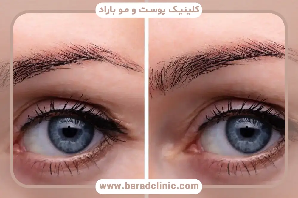 بوتاکس ابرو