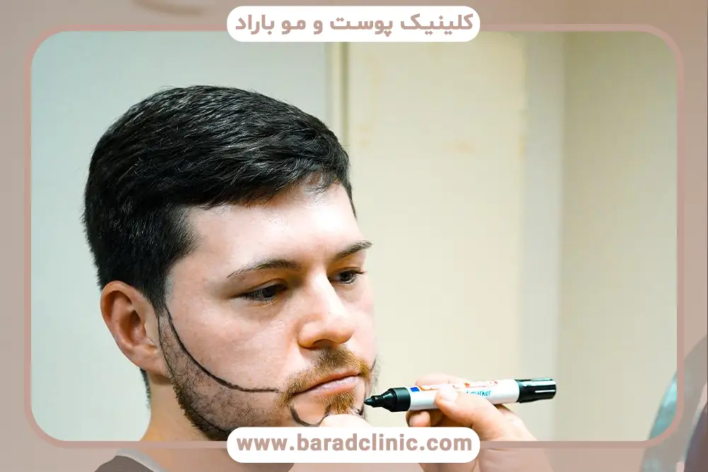 بهترین دکتر کاشت ریش در تهران