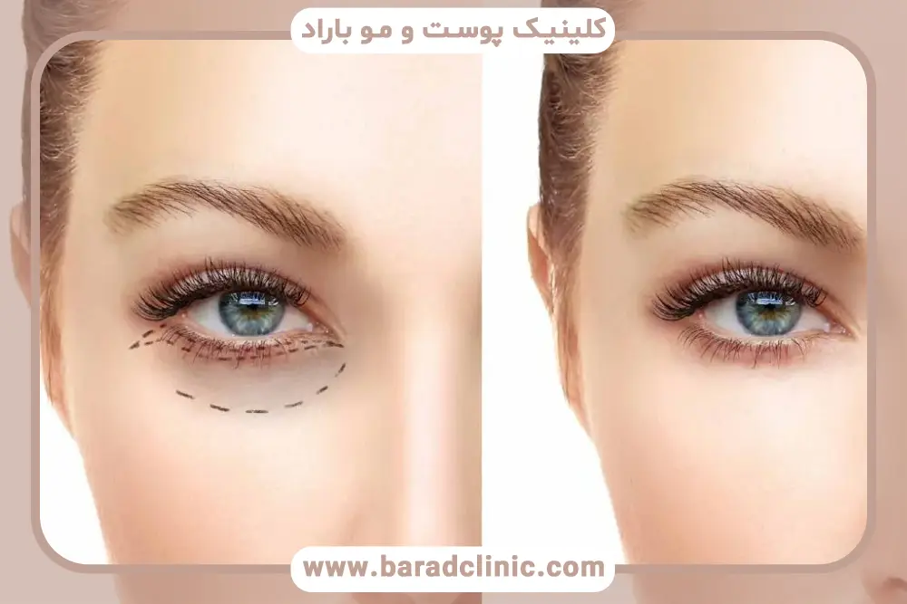 عمل زیبایی چشم بادامی