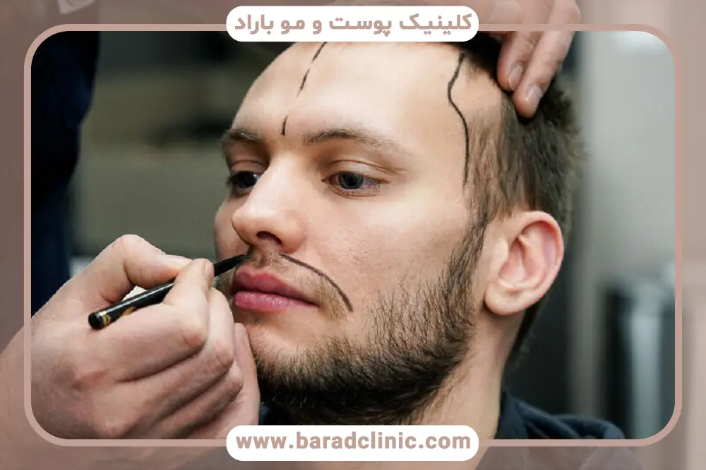 FUT یکی از انواع روش کاشت ریش 