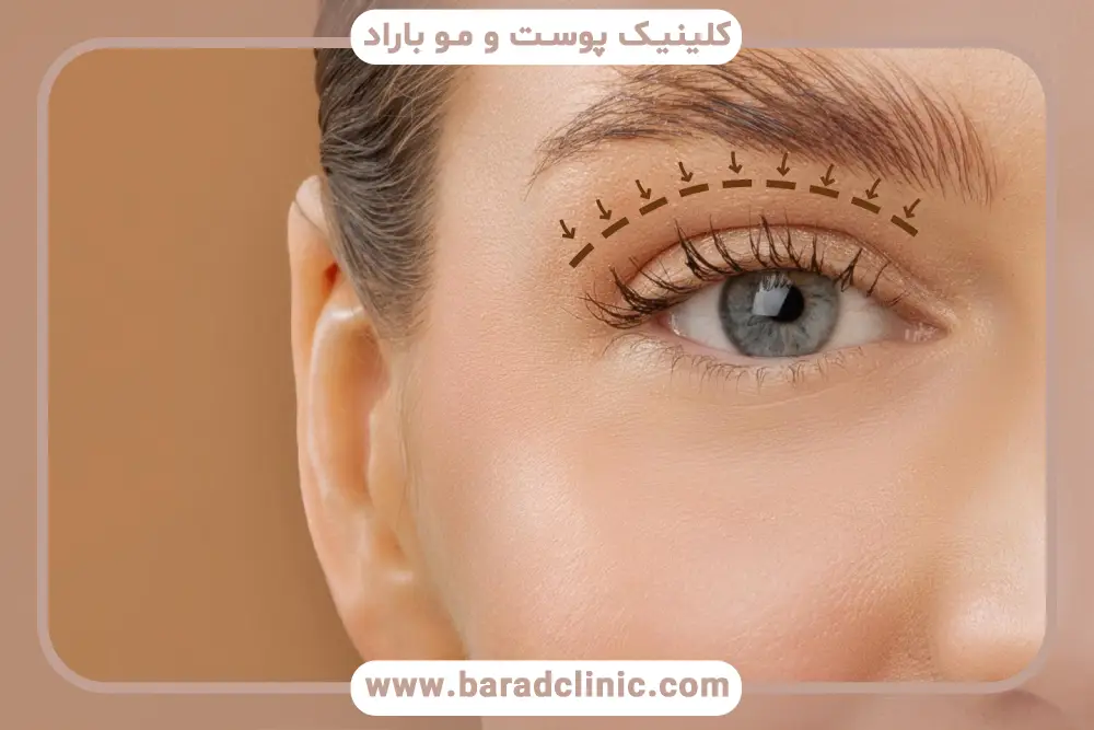 آشنایی با جراحی بلفاروپلاستی فوقانی