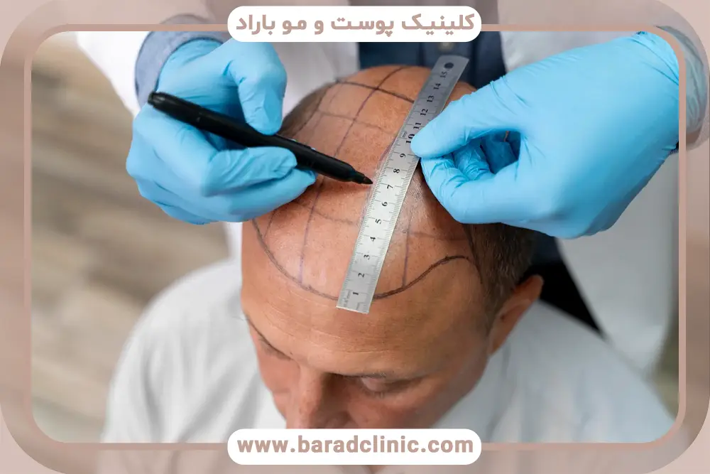 سن از مهمترین شرایط کاشت مو
