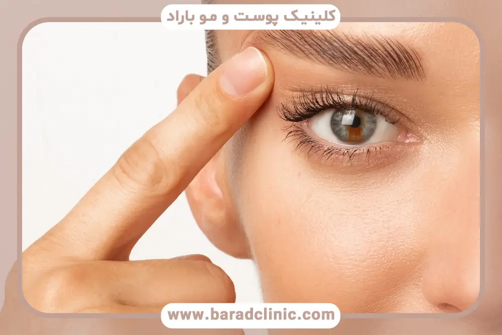 جراحی بلفاروپلاستی تحتانی چیست؟