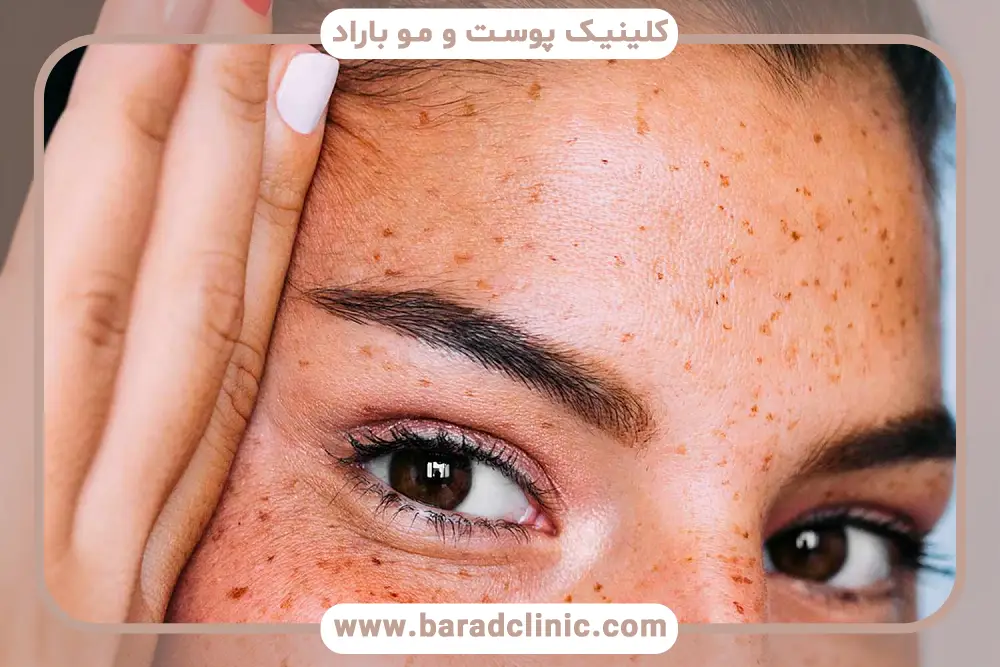 بوتاکس ابرو چیست؟ 