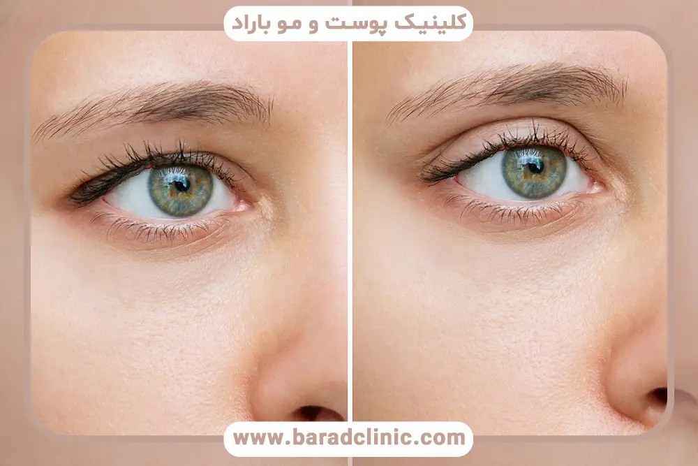 عوامل موثر بر هزینه عمل افتادگی پلک