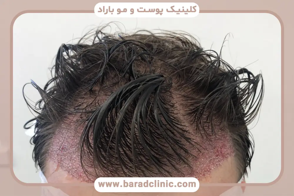 انتخاب بهترین روش کاشت با عکس کاشت مو تازه