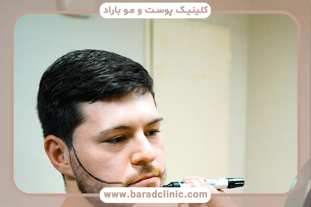 میکروگرافت از انواع روش کاشت ریش 