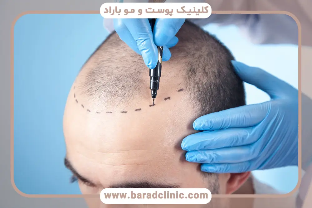 بانک مو از شرایط کاشت مو