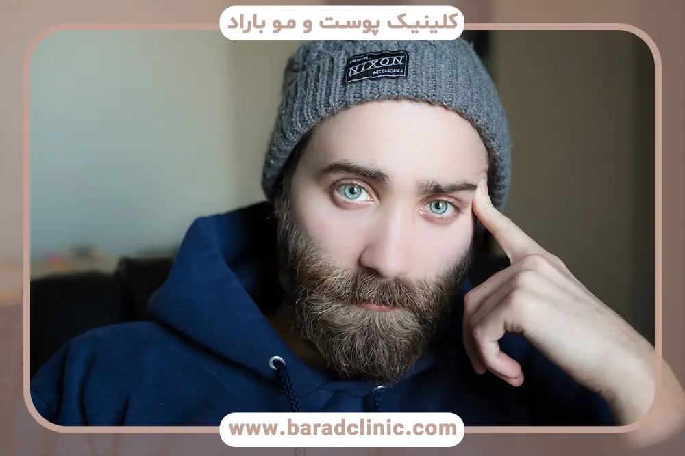 روشهای کاشت ریش و سبیل