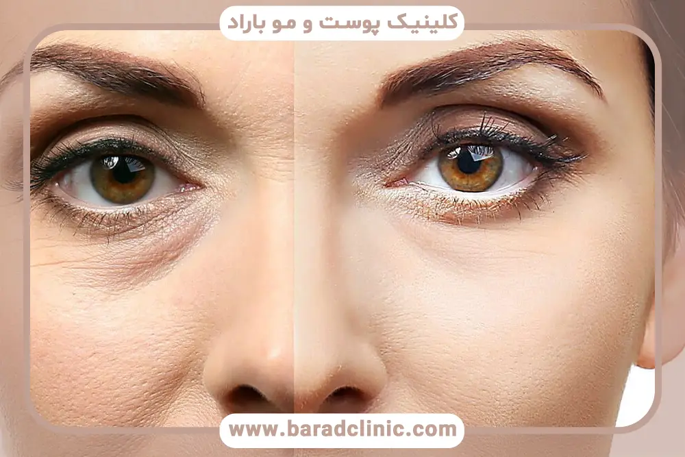 آمادهسازی جراحی بلفاروپلاستی تحتانی