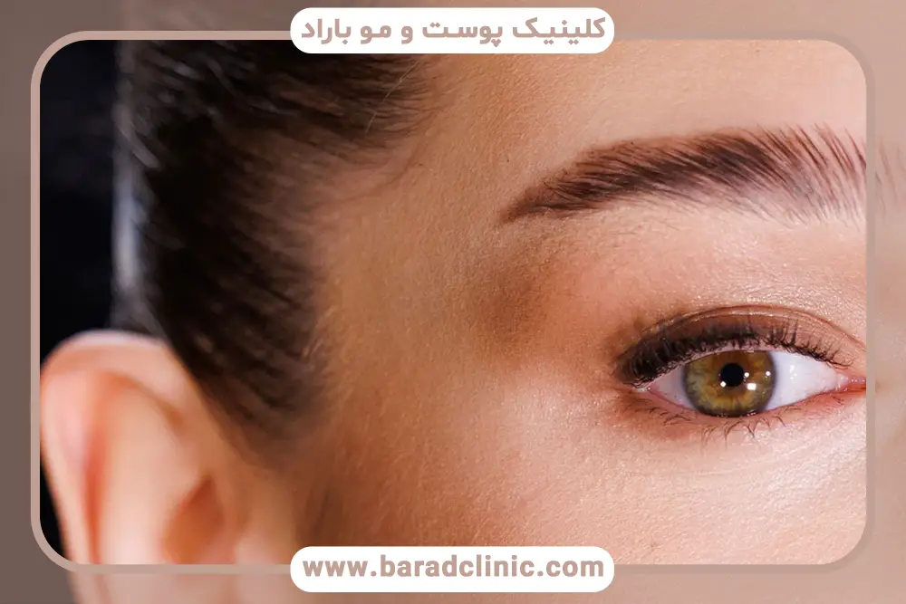 تفاوت بوتاکس ابرو با لیفت