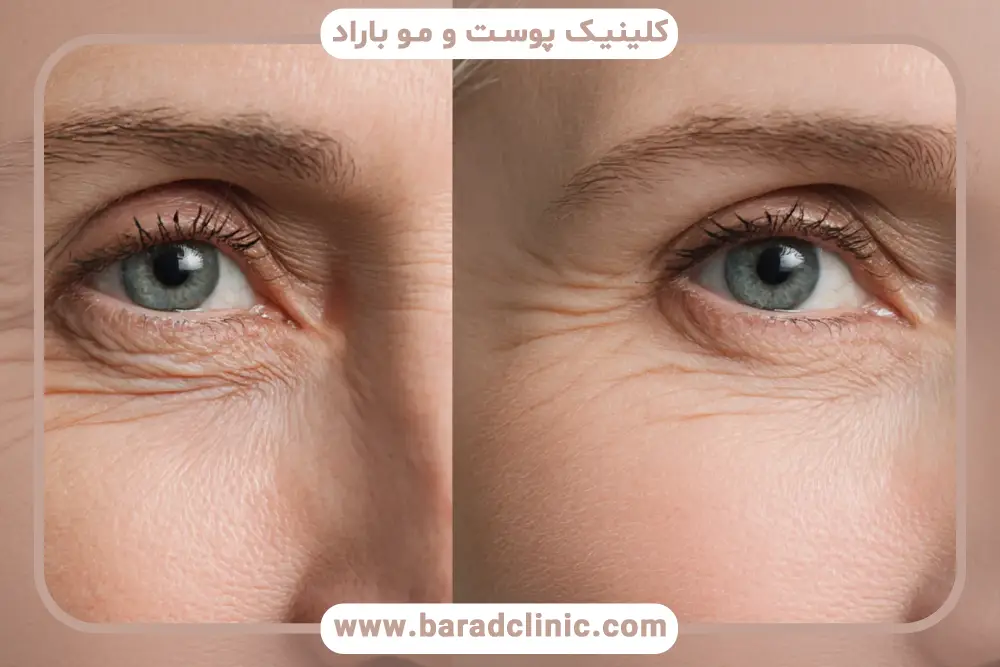 مزوتراپی زیر چشم چگونه انجام میشود؟ مراحل