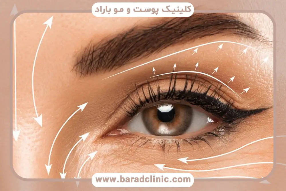 پوشش هزینه عمل افتادگی پلک با بیمه