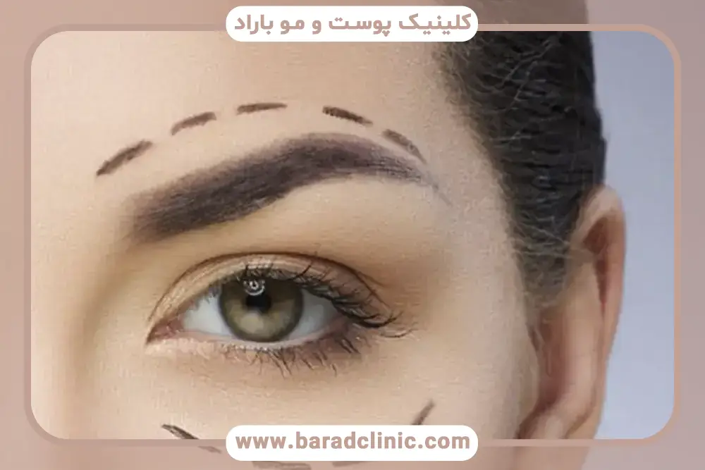 برش کانتوپلاستی از انواع تکنیک های برش در بلفاروپلاستی