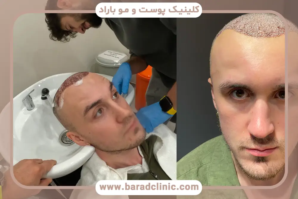 اطلاعات مهم عکس کاشت مو تازه