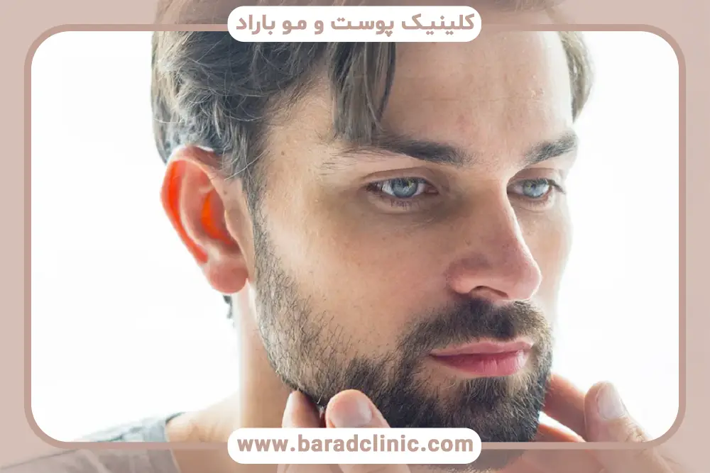 انتخاب بهترین گزینه از انواع روش کاشت ریش 