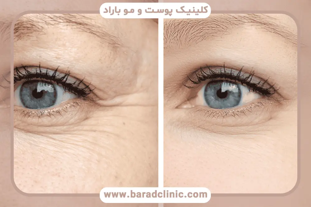 مراقبتهای بعد از جراحی بلفاروپلاستی فوقانی